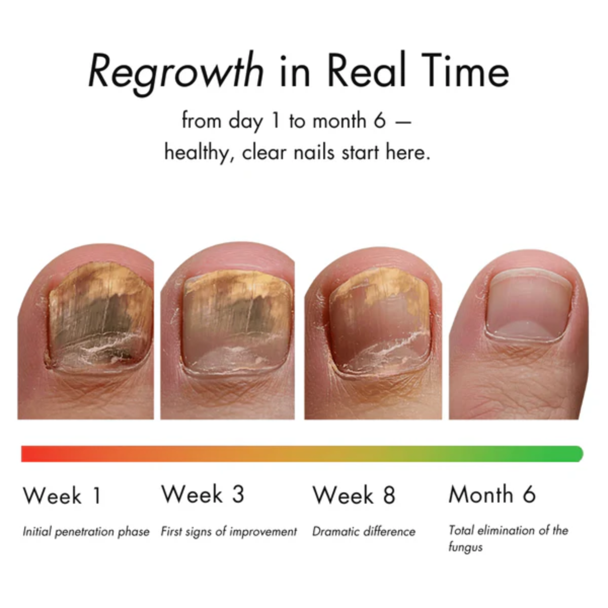 Eliminate fungal infections and prevent nail damage with DermNail.