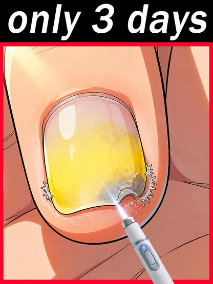 Blue Light Fungal Nail Treatment Pen